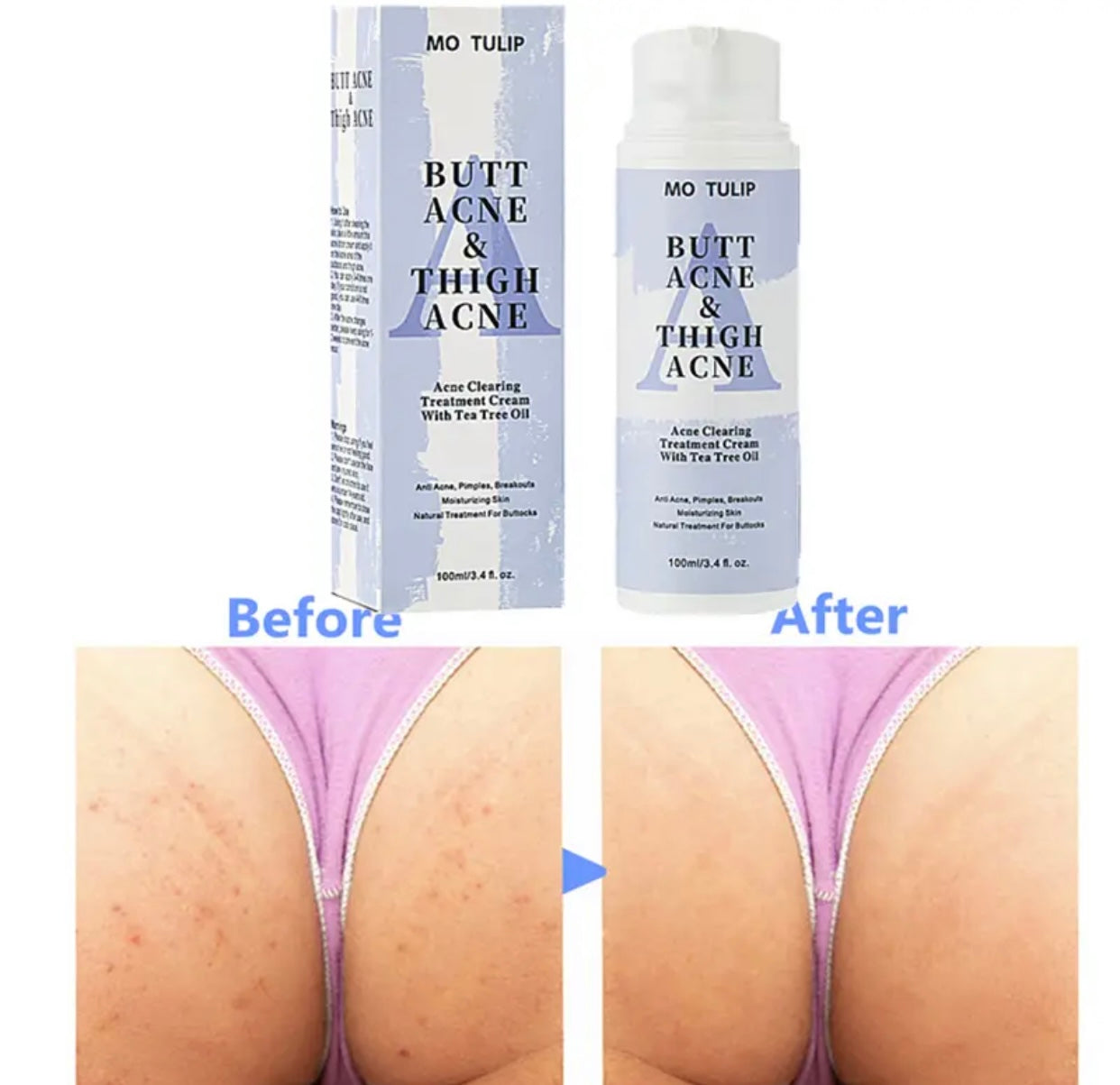 Butt & Thigh Acne Cream